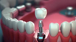 Smile designing treatment for perfect smile makeover